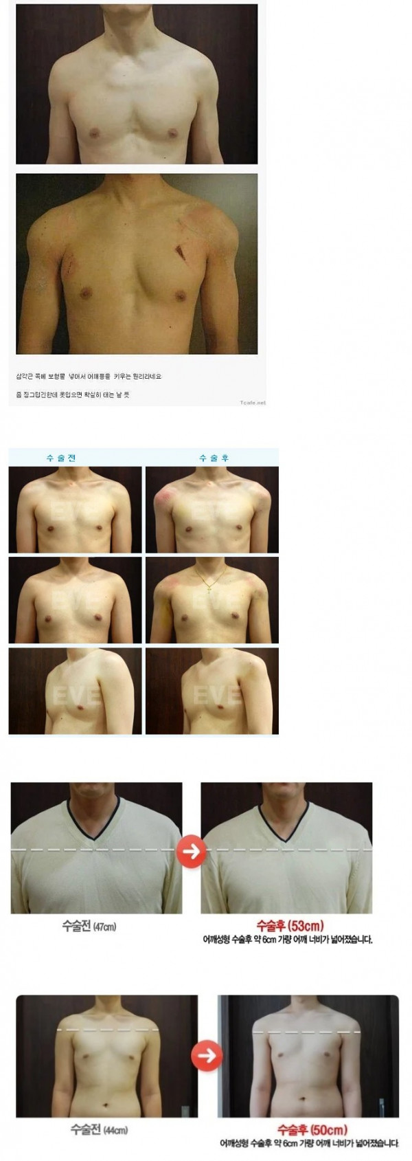 남자 어깨 넓이 성형수술